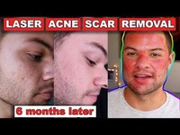 Thumbnail for the Nick DiRamio - Acne Scar Removal Before And After 6 Months: Fractional C02 Laser Skin Resurfacing link, provided by host site
