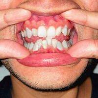 Thumbnail for the Toast - broken jaw link, provided by host site