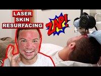 Thumbnail for the Nick DiRamio - Laser Skin Resurfacing - Getting Fractional C02 Laser Procedure for Acne Scar Removal link, provided by host site